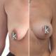 Bruststraffung mit Implantat