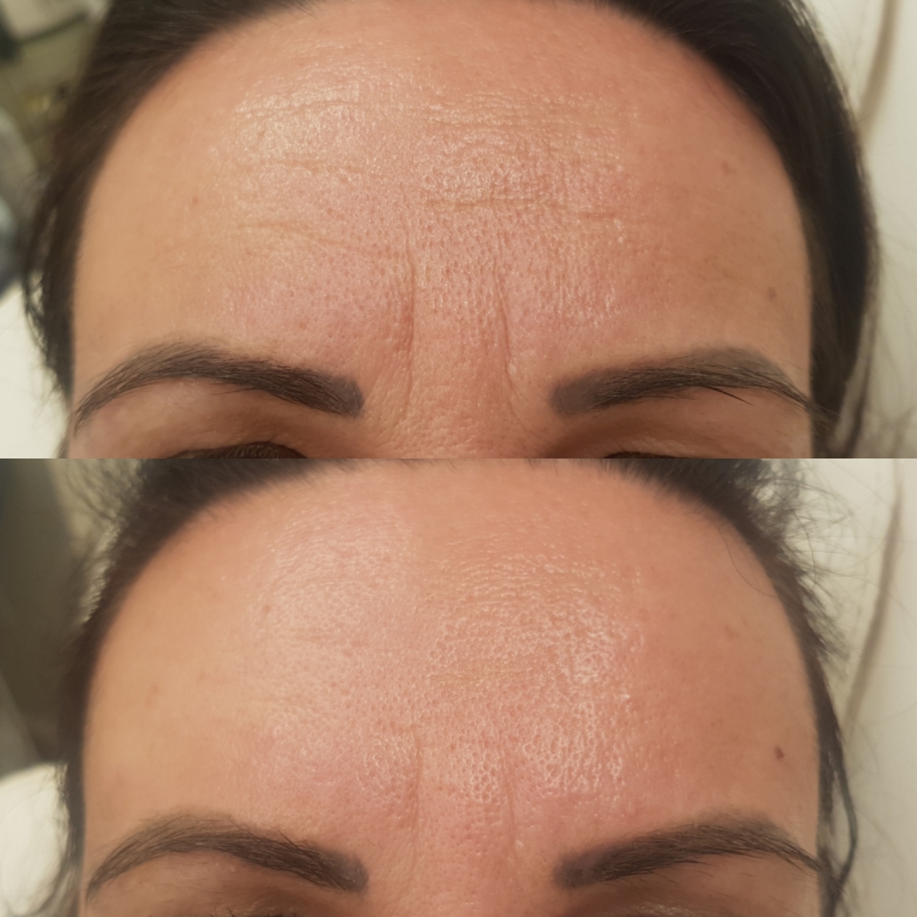 Botox Wien Stirnfalten Zornesfalte Krahenfusse Augenbrauen U V M