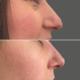 Rhinoplastik Wien