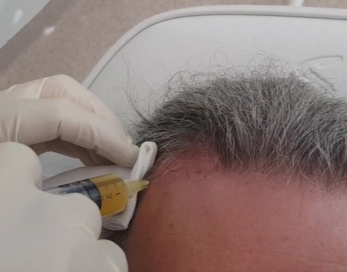 PRP Behandlung der Kopfhaut bei schütterem Haar Wien