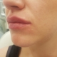 Kozlowski - Lippenbehandlung