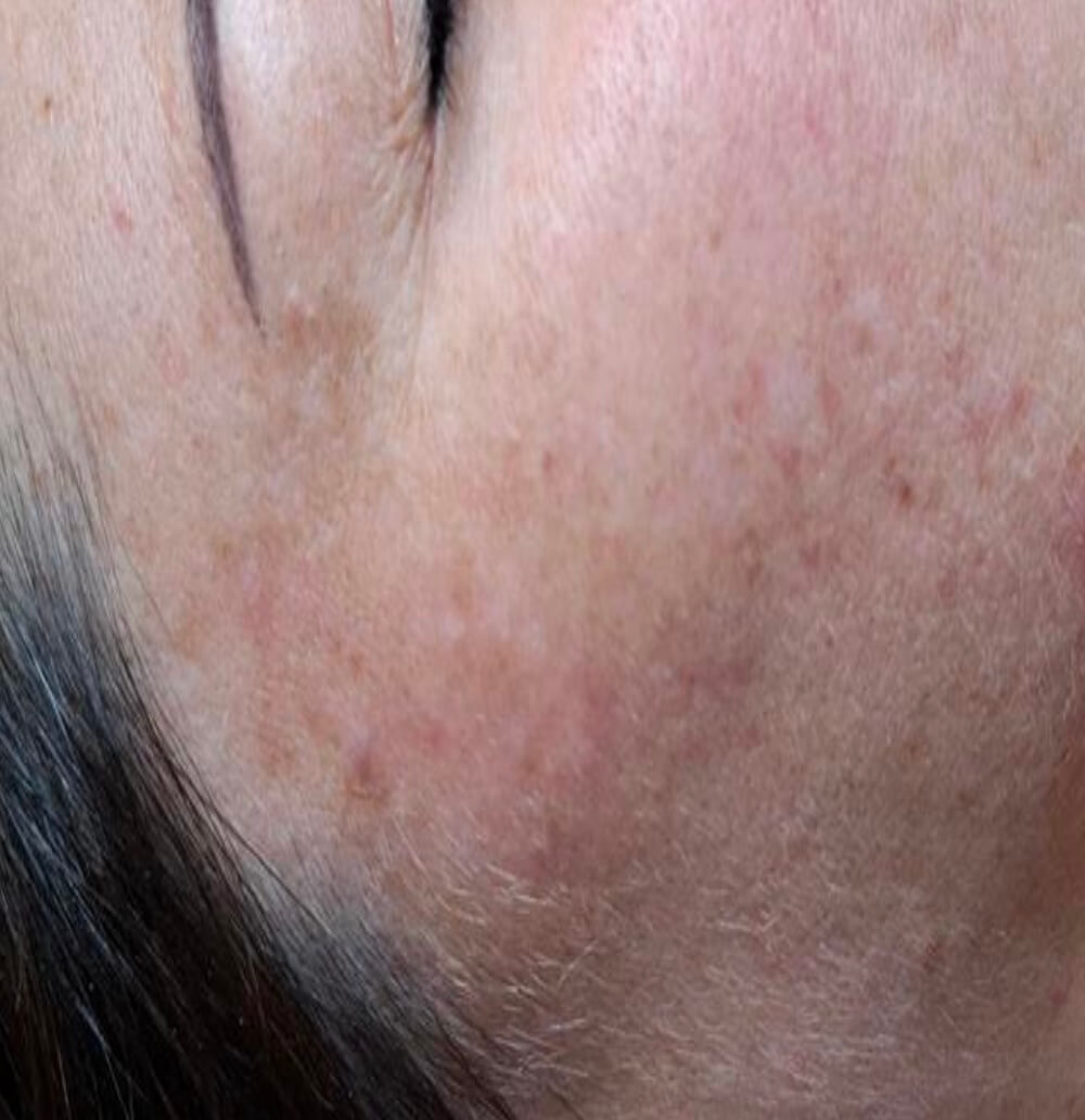 Pigment Entfernung 2 Pigment Entfernung 2 Pigmentflecken Entfernen mit Pico Laser in Wien