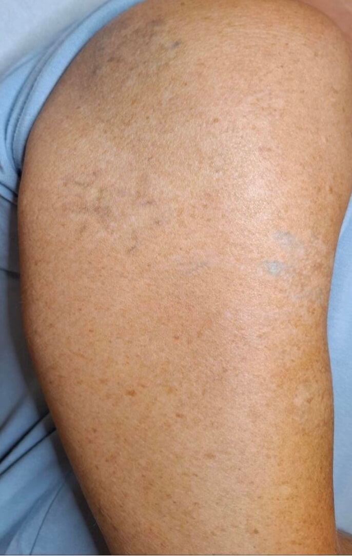 Tattoo Entfernung 2 Tattoo Entfernung 2 Pigmentflecken Entfernen mit Pico Laser in Wien