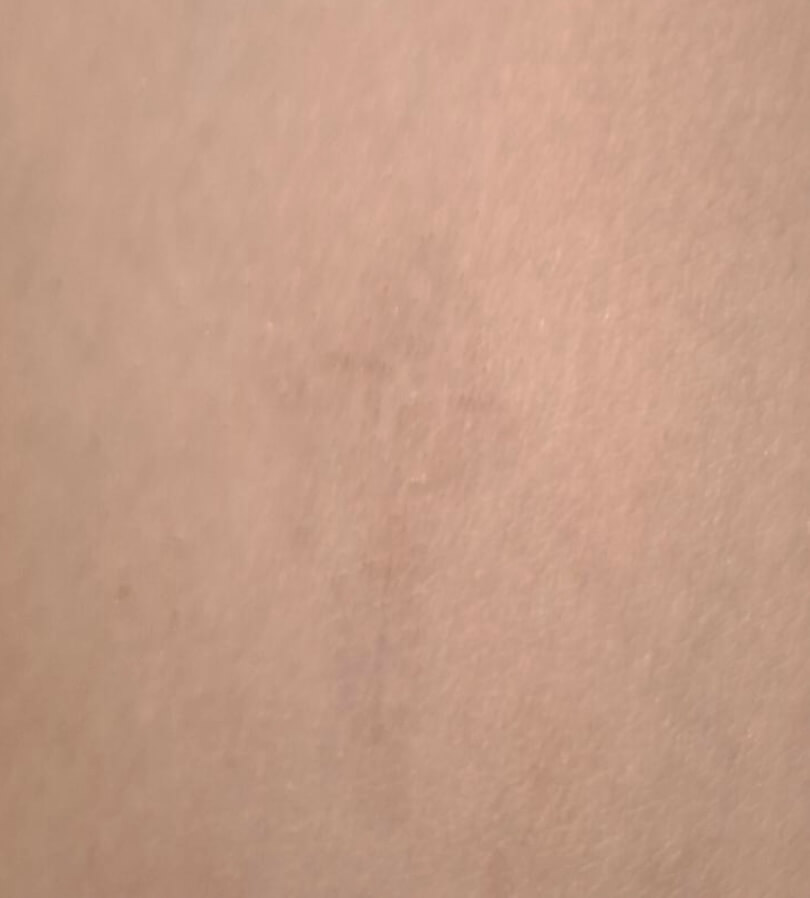 Tattoo Entfernung Wien 2 Tattoo Entfernung Wien 2 Pigmentflecken Entfernen mit Pico Laser in Wien