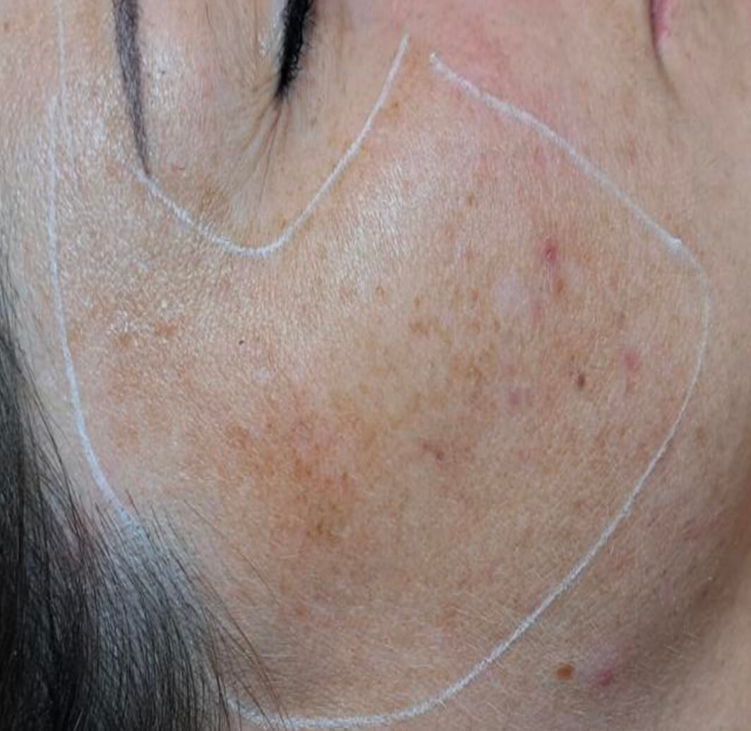 pigment entfernung 1 pigment entfernung 1 Pigmentflecken Entfernen mit Pico Laser in Wien