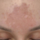 Melasma behandlung Wien