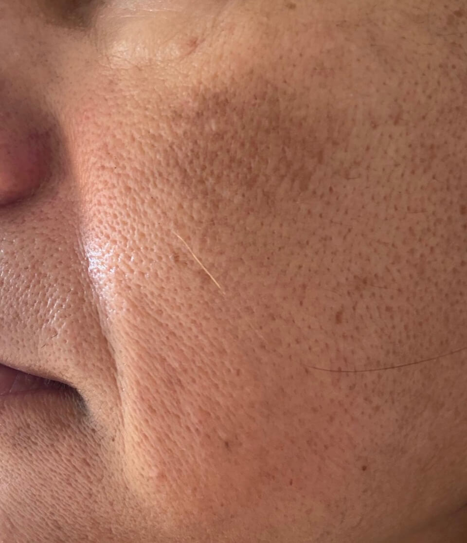 Pigmentflecken entfernen Wien – Dr. Kozlowski