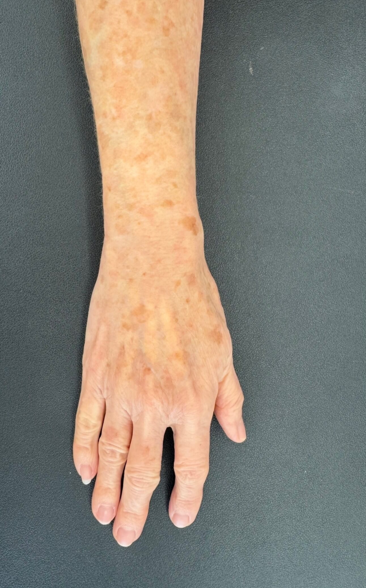 Pigmentflecken entfernen Wien – Laserbehandlung